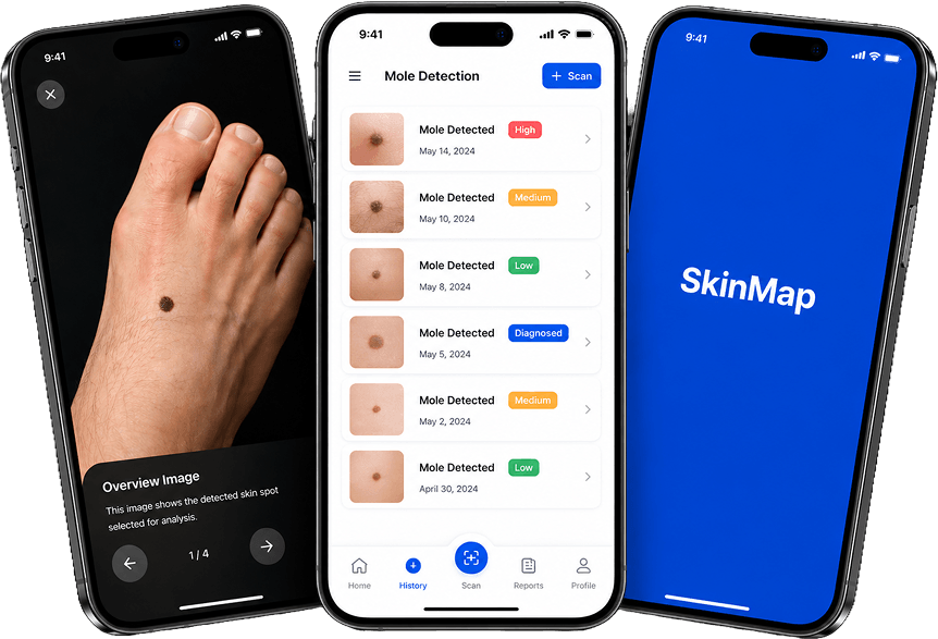 AI for skin cancer detection 
